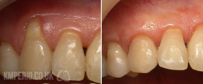 Treatment of Gingival Receding Gums by Cosmetic Plastic Surgery